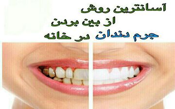  جرم گیری طبیعی دندان ها در منزل/ بیا تا 6 روش نشونت بدم!