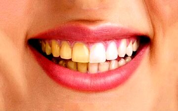  زردی دندان‌ها نشانه چیست؟