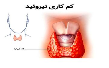 بی علامتی مشکل تیروئید در نوزادان؛غربالگری بهترین راهکار!