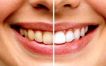 رنگ دندان چه چیزهایی درباره سلامت شما می‌گوید؟