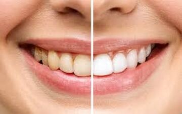 رنگ دندان چه چیزهایی درباره سلامت شما می‌گوید؟