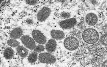 مدت زمان نهفتگی آبله میمون چقدر است؟