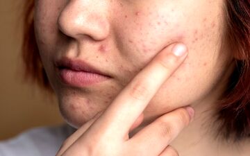 غذاهای جوش آور؛ چه غذاهایی باعث جوش زدن صورت می شود