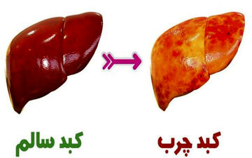 نکات مهم در تغذیه افراد مبتلا به کبد چرب