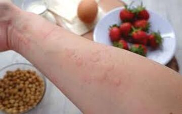 آلرژی‌های غذایی از چه سنی ممکن است شروع شود؟