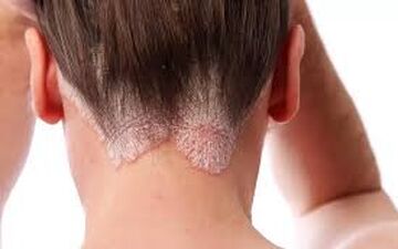 پسوریازیس چیست+ پیشگیری و درمان
