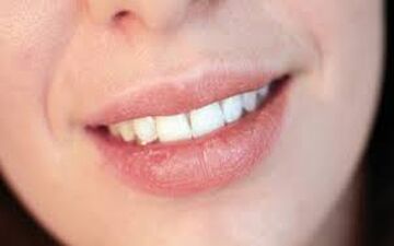  خشکی دهان؛ علل و راههای درمان آن
