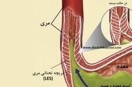 درمان ریفلاکس معده در خانه!