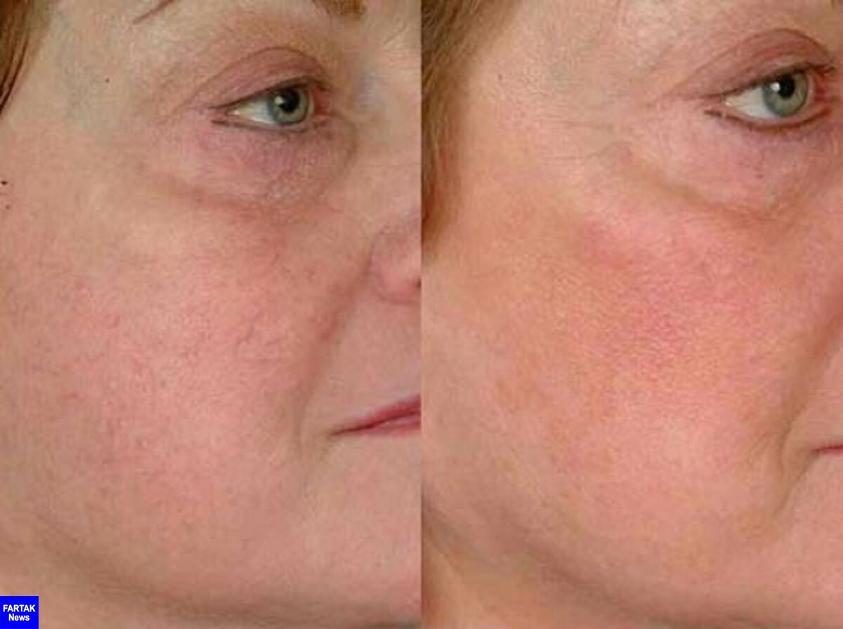 دلایل ایجاد رگ‌های عنکبوتی بر روی صورت چیست؟ + درمان 