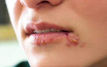 اگر تبخال دارید، بخوانید