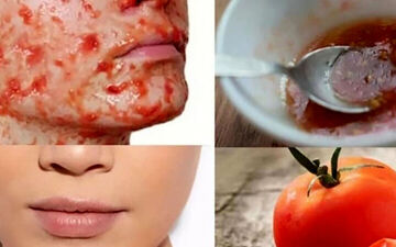 ماسک صورت خانگی برای درمان جوش صورت و تنظیم چربی پوست 