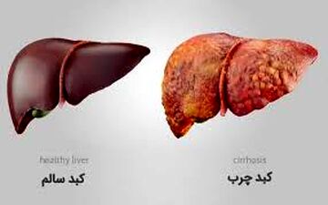 کم آبی دشمن کبد شماست​