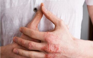 مشکلات پوستی؛شایع ترین بیماری های رایج پوستی در فصل بهار