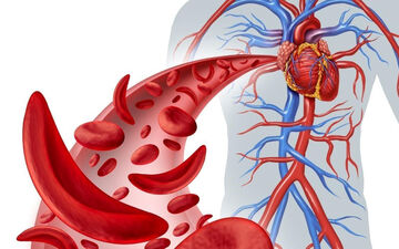 علائم کمبود آهن در بدن چیست؟