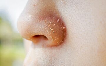 پوسته پوسته شدن روی بینی| دلیل پوسته پوسته شدن روی بینی چیست؟