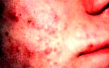استرس چگونه باعث کهیر یا بثورات پوستی می‌شود؟