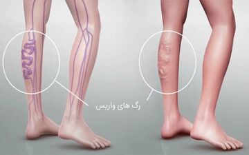خطر ابتلا به واریس با کمبود این ویتامین چند برابر می‌شود