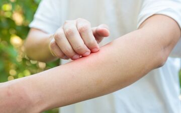 چگونگی جلوگیری از خارش و التهاب پوستی در فصل بهار

