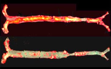 پادتن از التهاب جلوگیری می‌کند