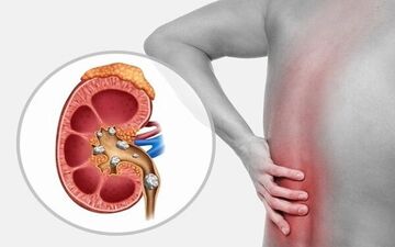 چه چیزهایی باعث سنگ ساز شدن کلیه ها می شود؟