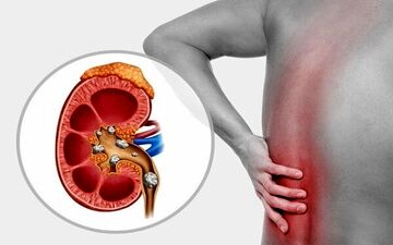 چه چیزهایی باعث سنگ ساز شدن کلیه ها می شود؟