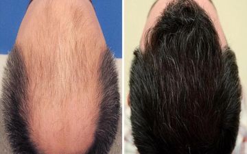 آیا کاشت مو برای همیشه می‌ماند یا دوباره می‌ریزد؟