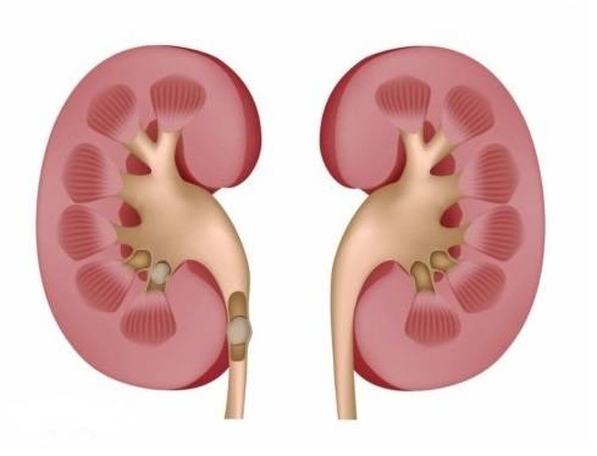 سنگ کلیه و بخور و نخورهایی که باید رعایت کنید