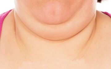  چگونه چربی گردن را از بین ببریم؟
