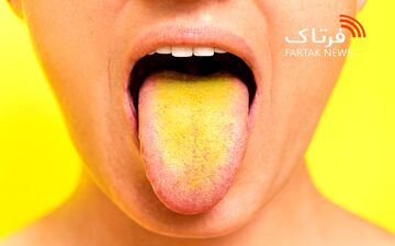 زردی زبان؛ از تغییرات بی‌خطر تا نشانه‌های بیماری‌های خطرناک