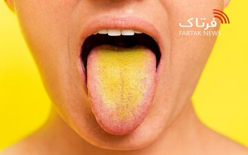 زردی زبان؛ از تغییرات بی‌خطر تا نشانه‌های بیماری‌های خطرناک