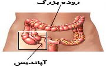  ۶راهکار ساده طب سنتی برای پیشگیری از آپاندیس