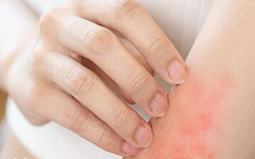 هنگام خارش ناشی از اگزما چه باید کرد؟