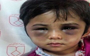  چهره کبود شده دختر اصفهانی / این ماجرا اشک همه را در می آورد