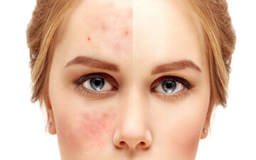 برای اینکه تابستون جوش نزنیم چیکار کنیم؟ | جلوگیری از جوش زدن در گرما + راه های درمان