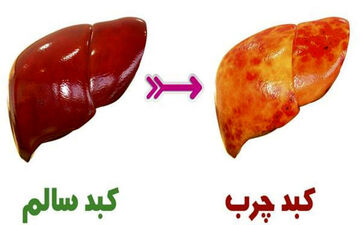 نشانه‌های اولیه کبد چرب که باید بدانید
