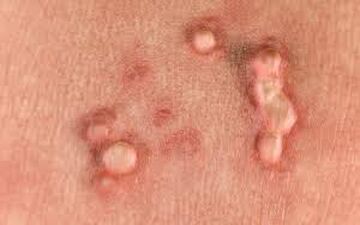 چگونه میشود فهمید که HPV داریم؟


