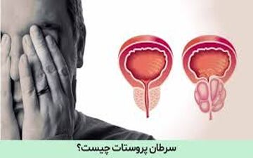 هشدار به مردان؛ این نشانه‌ها می‌تواند زنگ خطر سرطان پروستات باشد