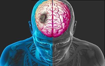 علت بروز سکته مغزی چیست؟ | حقایقی در مورد سکته مغزی