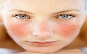  سرخ شدن صورت نشانه چیست؟