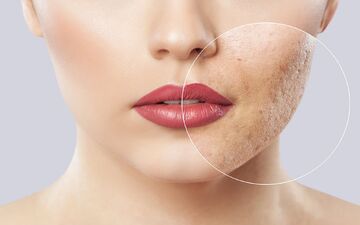 با جای جوش‌ها چه کنم؟ | درمان جای جوش