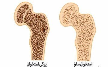 پوکی استخوان و سارکوپنی دو بیماری خاموش سنین بالای ۵۰ سال