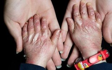 بیماران انگشت‌شماری که دردهایشان بی‌شمار است