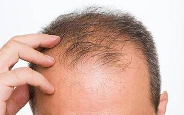 داروهای ضد ریزش مو خطر ناتوانی جنسی را افزایش می دهند
