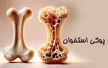 زنان بیش از مردان در معرض ابتلا به پوکی استخوان هستند