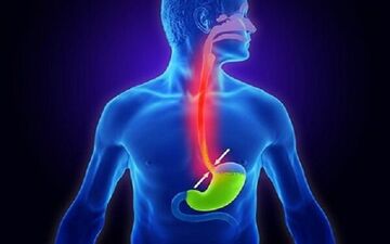 آیا استرس می‌تواند عامل رفلاکس و سوزش معده شود؟