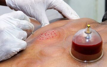 حجامت می‌تواند جایگزین واکسن کرونا باشد؟