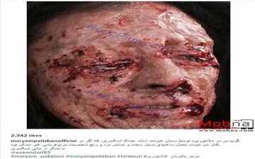 تصویری دلخراش از اسیدپاشی روی صورت خانم بازیگر!