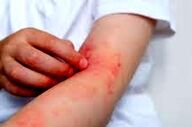 آلرژی به بادمجان این علائم را دارد