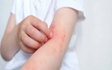 آلرژی به بادمجان این علائم را دارد