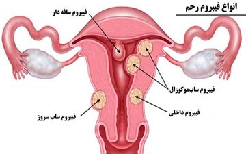 ایجاد فیبروم به چه علت است؟